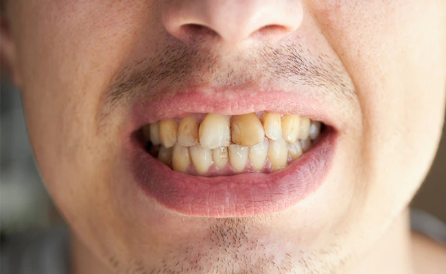 How To Whiten Yellow Teeth