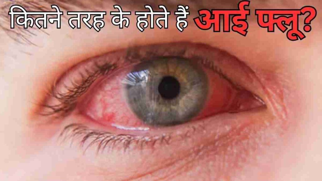 Eye Flu Prevention Wikipedia